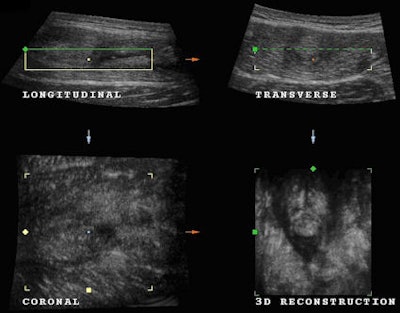 Fig. 5: Multiplanar imaging shows absorption of some of the hematoma but demonstrates the presence of the muscle tear.