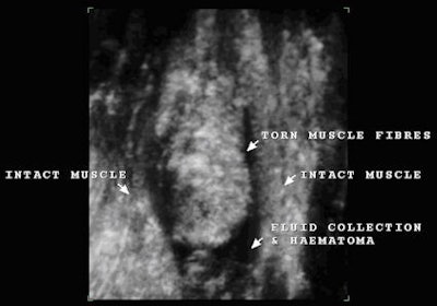 Fig. 4: 3D reconstruction (enlarged image) demonstrating the intact vastus intermedius and vastus lateralis with the complete rupture of the central rectus femoris muscle. Note the black fluid collection and hematoma distally with coagulated material beneath the retracted swollen muscle.