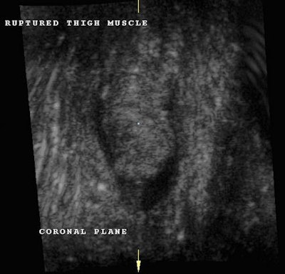 Fig. 2: Coronal plane clearly demonstrating the retracted muscle fibers with a swollen blunt end as a result of avulsion and surrounding hematoma. We noted a small quantity of coagulation material distally and deep to the tear.