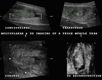 Fig. 3: Using multiplanar imaging and 3D reconstruction, it is possible to confirm the presence of the muscle tear at the level of the distal aponeurosis surrounded by hematoma or hypoechoic tissue related to hemorrhagic infiltration and coagulated material.