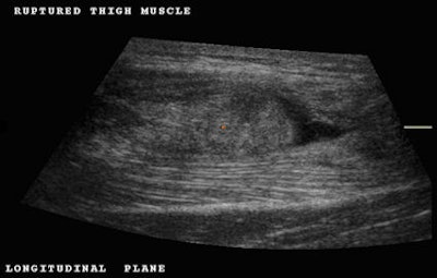 Fig. 1: Longitudinal plane demonstrating a distal aponeurosis tear. Note the retracted rounded end of the muscle and the presence of a distal hematoma (black area). All images courtesy of Dearbhla O'Dwyer and Dr. Stefano Ciatti.