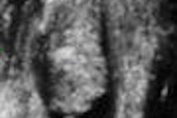 2008 06 10 13 44 22 20 Rectus Femoris Thumb 2008 06 16