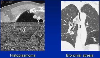 2008 06 20 10 59 55 158 White histoplasmoma atresia
