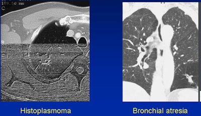 2008 06 20 10 59 55 158 White histoplasmoma atresia