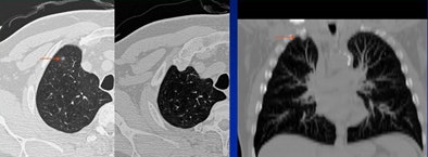 2008 06 20 11 00 00 140 White costocondral