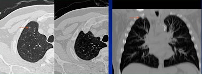 2008 06 20 11 00 00 140 White costocondral