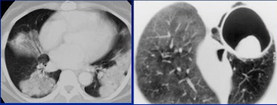 2008 06 20 11 00 01 909 White consolidated bronchoalveolar