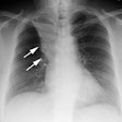 S Sign Cxr