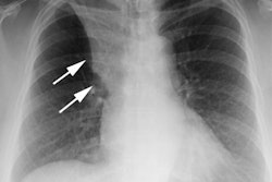 S Sign Cxr