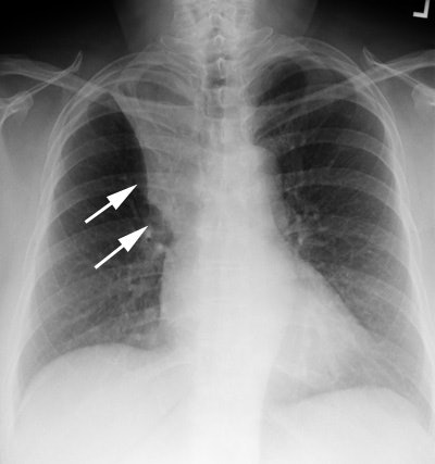 S Sign Cxr