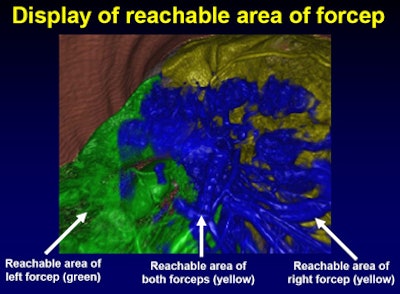2008 07 01 13 09 35 208 Mori reachable laparosscopic