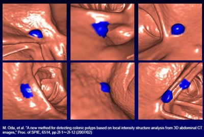 2008 07 01 13 09 47 120 Mori truepositivepolyps