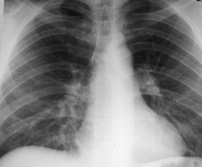 2008 07 02 15 39 38 154 2008 07 03 Crack Lung3