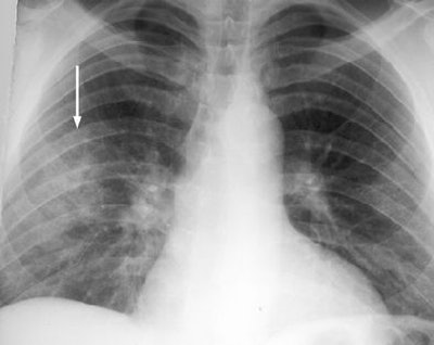 2008 07 02 15 39 39 597 2008 07 03 Crack Lung1