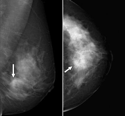 2008 07 11 13 32 10 109 2008 07 18 Breast Mr Iab