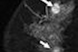 2008 07 11 13 32 11 461 2008 07 18 Breast Mri Thumb