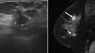 2008 07 11 13 32 11 837 2008 07 18 Breast Mr Icd