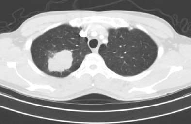 2008 08 07 15 16 16 735 Mcnitt lidcnodule