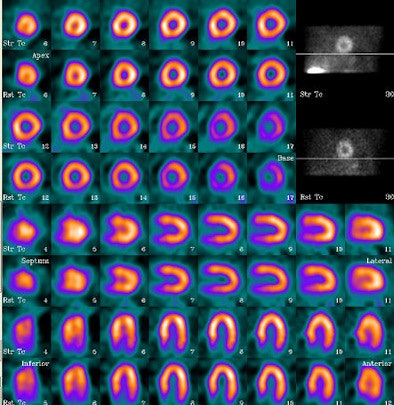 Ultrafast cardiac camera comparable to standard SPECT | AuntMinnie