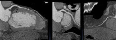 2008 09 29 10 16 07 241 Defrance cardiomyopathy