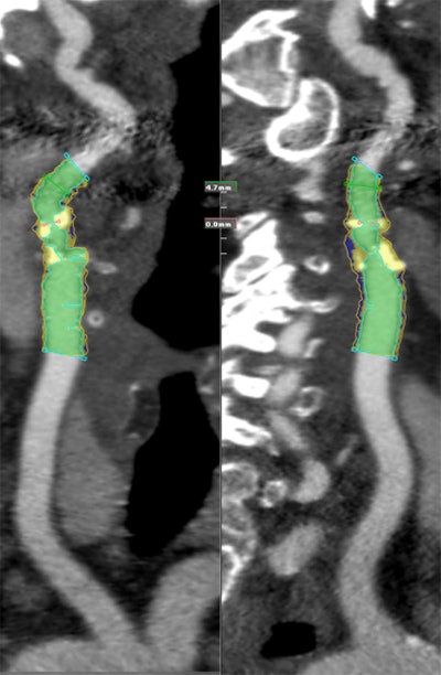 2008 10 15 10 55 54 825 77yo Fcarotid Bruitp Ct