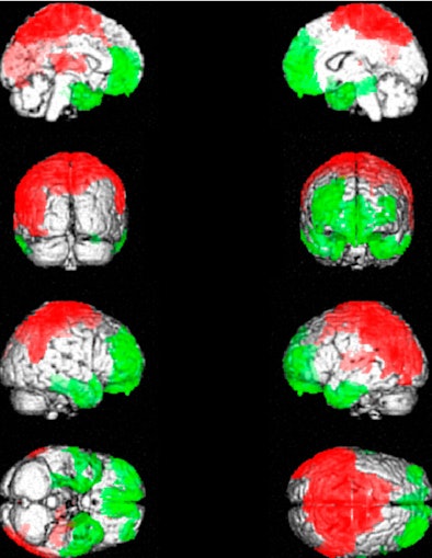 2008 10 31 14 13 54 357 2008 10 31 Fibromyalgia Resized