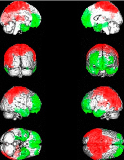 2008 10 31 14 13 54 357 2008 10 31 Fibromyalgia Resized