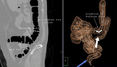 2008 11 03 17 40 01 890 Zafar priorhysterectomy
