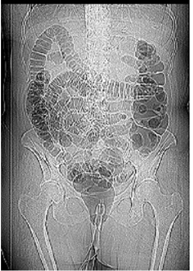 2008 11 17 16 44 56 10 Friedman largercatheter