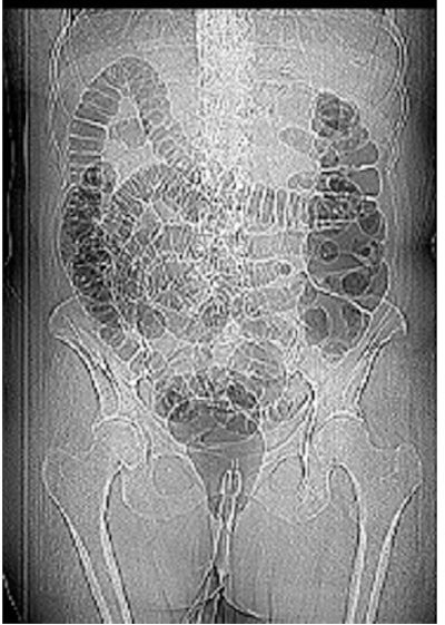 2008 11 17 16 44 56 10 Friedman largercatheter