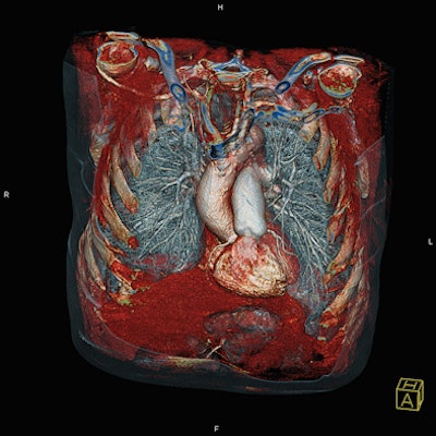 2008 11 21 16 32 50 917 Siemens Definition Lung Resized