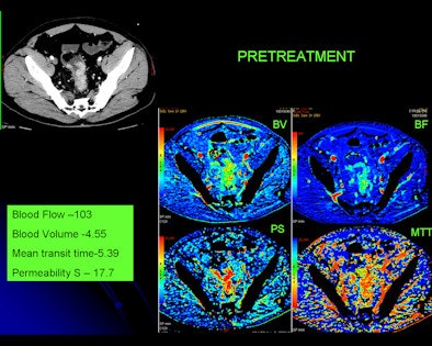 2008 11 30 18 30 13 2 Pretreatment