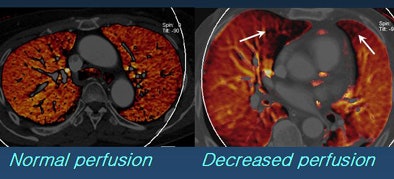 2008 12 01 18 22 46 994 Kang abnormalperfusion