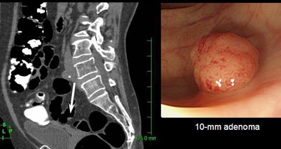 2009 03 07 12 00 15 770 Nappi 10mmadenoma