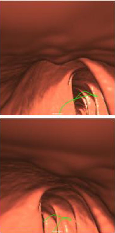 2009 03 10 14 56 05 6 Summers hyperplastic