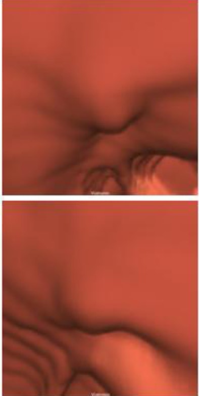 2009 03 10 14 56 07 660 Summers adenoma