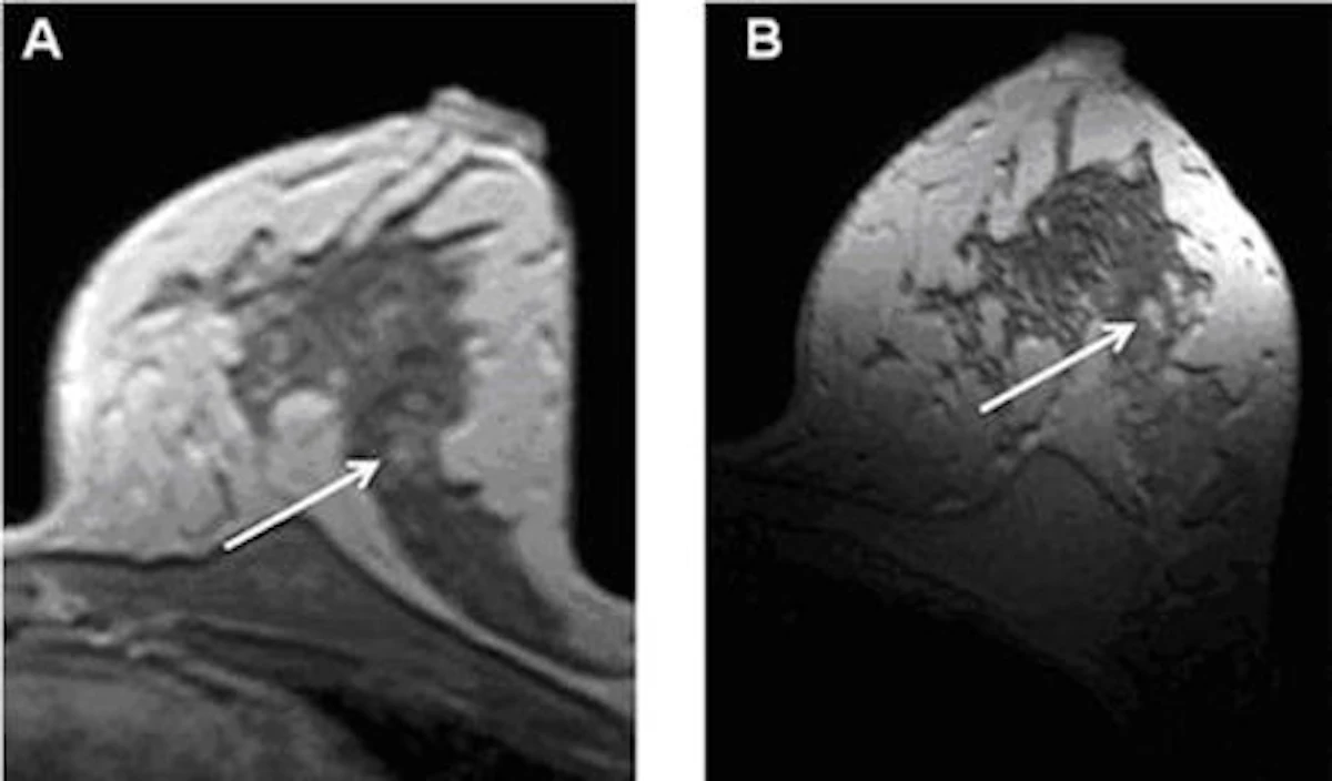 7-tesla breast MRI shows advantages in first tests | AuntMinnie