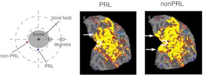 2009 04 07 15 06 59 336 Macular Degeneration2 450
