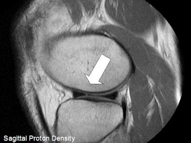 2009 06 23 11 56 30 769 Harsha Meniscus 394