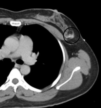 2009 09 01 13 38 13 663 Mendel ctguided biopsy