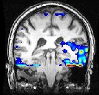 2009 10 05 13 32 38 67 Meg Tinnitus 394