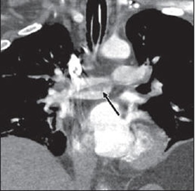 2009 10 20 13 30 49 618 Agarwal saddleembolus