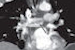 2009 10 20 15 39 50 815 Agarwal saddleembolus Newthumb