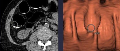 2009 10 28 12 25 53 582 Lawrence submucosal lipoma