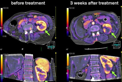 2009 11 05 12 28 24 361 Rogalla renalcancer
