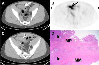 FDG-PET/CT helps manage treatment for Crohn's disease | AuntMinnie