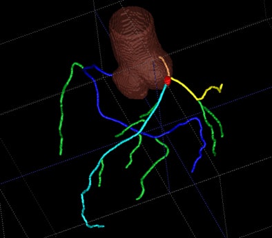 2009 11 16 12 48 02 765 Schoepf coronarytree jpg