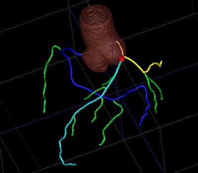 2009 11 16 12 48 02 765 Schoepf coronarytree jpg