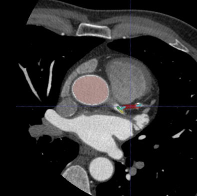 2009 11 16 12 48 04 184 Schoepf axialct jpg