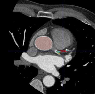 2009 11 16 12 48 04 184 Schoepf axialct jpg